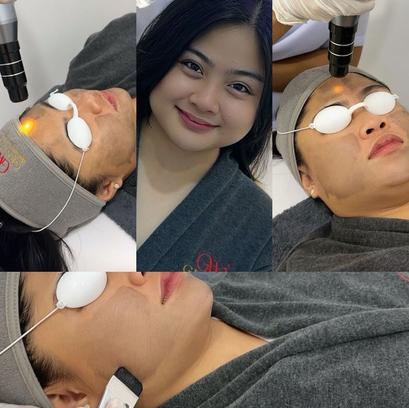 Carbon Laser Peel